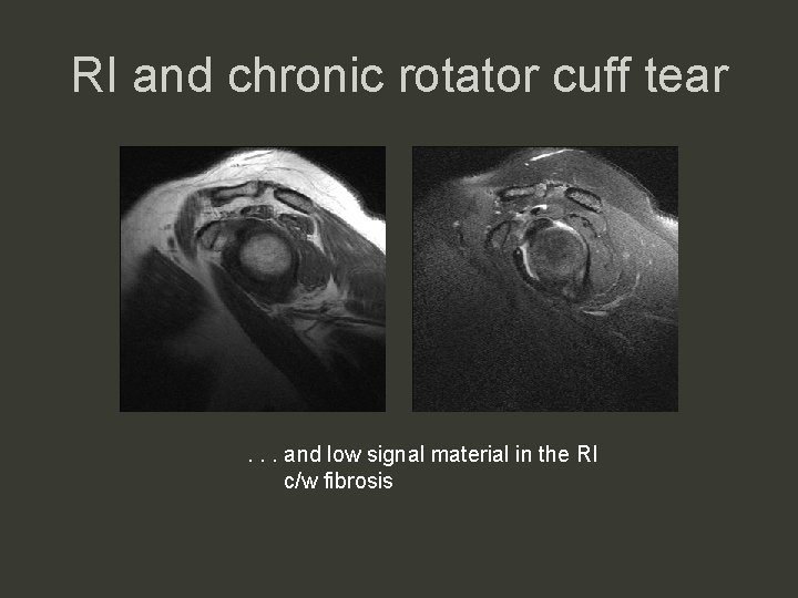 RI and chronic rotator cuff tear . . . and low signal material in