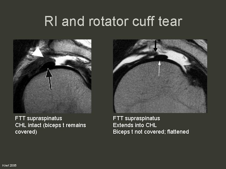 RI and rotator cuff tear FTT supraspinatus CHL intact (biceps t remains covered) Krief