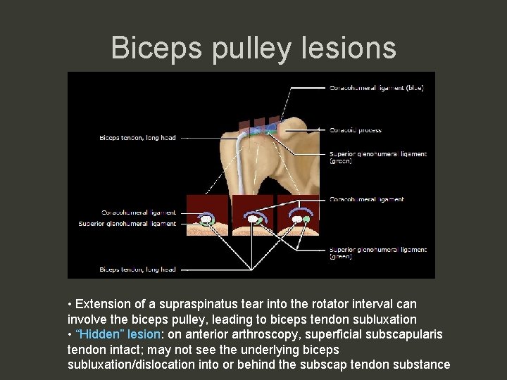 Biceps pulley lesions • Extension of a supraspinatus tear into the rotator interval can