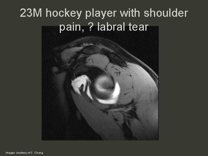 23 M hockey player with shoulder pain, ? labral tear Images courtesy of C.