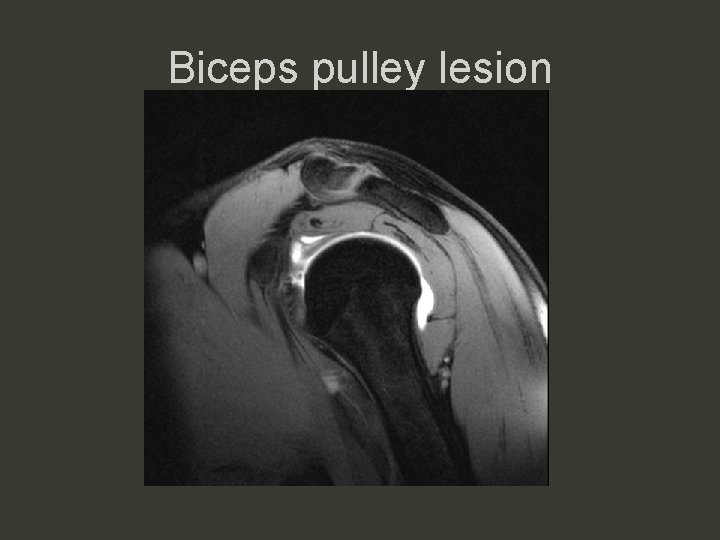 Biceps pulley lesion 