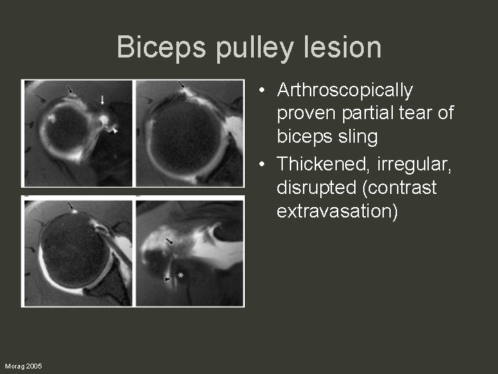 Biceps pulley lesion • Arthroscopically proven partial tear of biceps sling • Thickened, irregular,