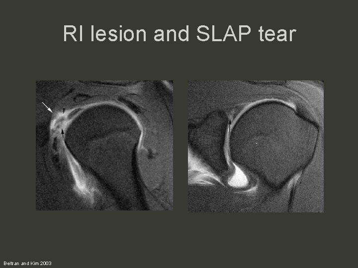 RI lesion and SLAP tear Beltran and Kim 2003 