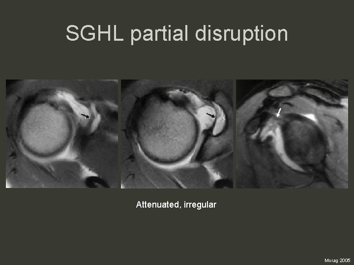 SGHL partial disruption Attenuated, irregular Morag 2005 