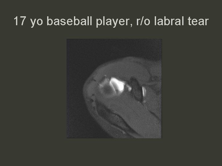 17 yo baseball player, r/o labral tear 