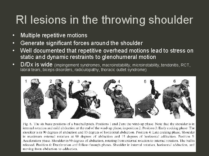 RI lesions in the throwing shoulder • Multiple repetitive motions • Generate significant forces