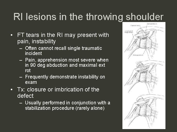 RI lesions in the throwing shoulder • FT tears in the RI may present