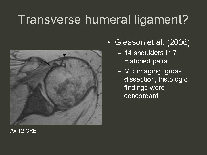 Transverse humeral ligament? • Gleason et al. (2006) – 14 shoulders in 7 matched