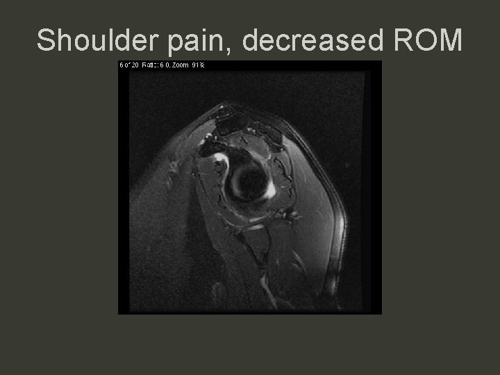 Shoulder pain, decreased ROM 