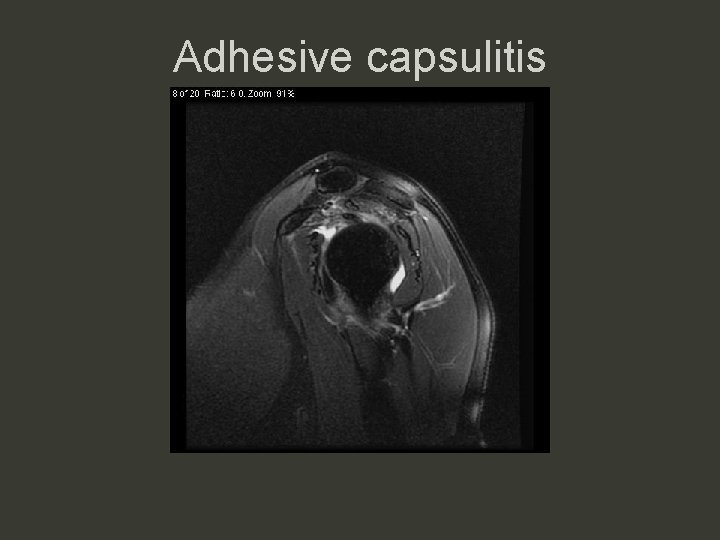 Adhesive capsulitis 