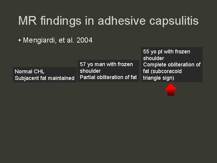 MR findings in adhesive capsulitis • Mengiardi, et al. 2004 Normal CHL Subjacent fat