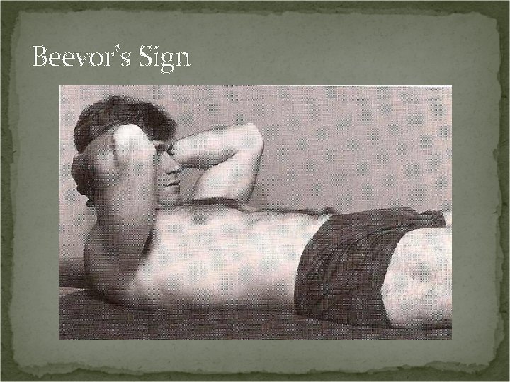 Beevor’s Sign 