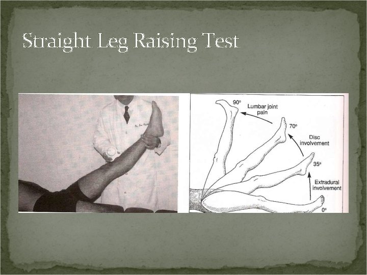 Straight Leg Raising Test 