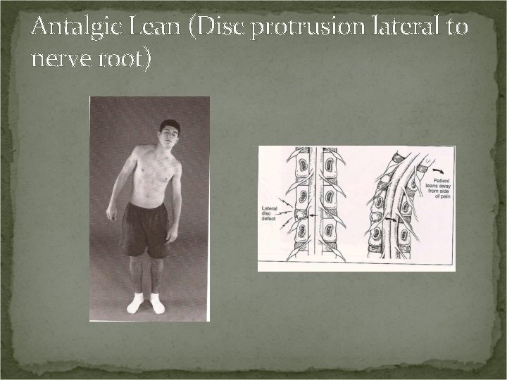 Antalgic Lean (Disc protrusion lateral to nerve root) 