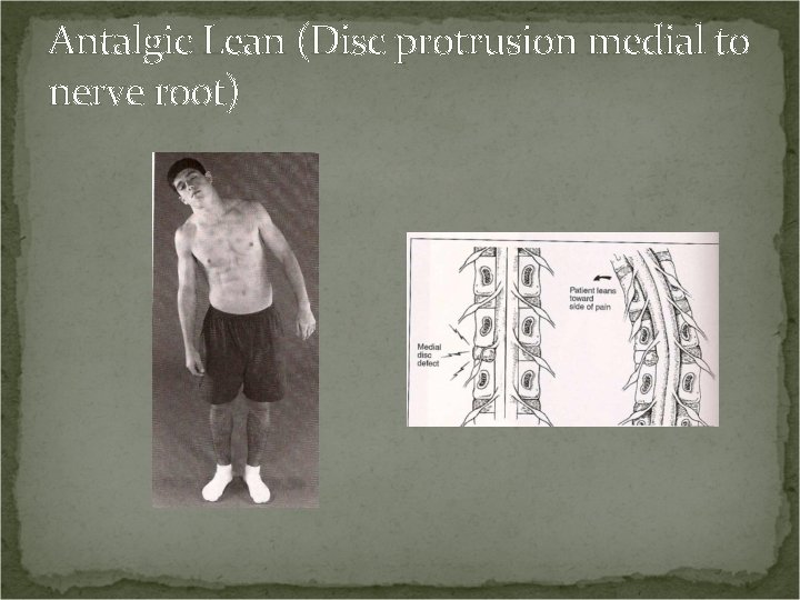 Antalgic Lean (Disc protrusion medial to nerve root) 