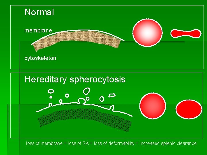 Normal membrane cytoskeleton Hereditary spherocytosis loss of membrane = loss of SA = loss