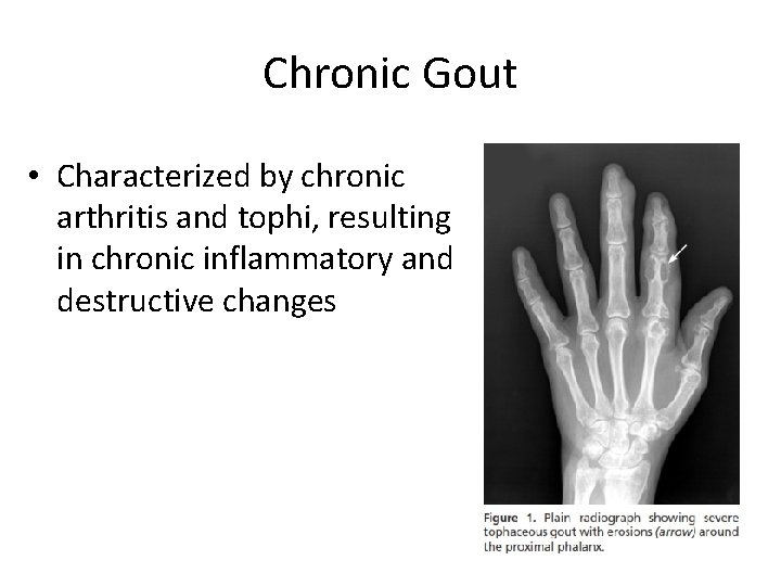 Chronic Gout • Characterized by chronic arthritis and tophi, resulting in chronic inflammatory and