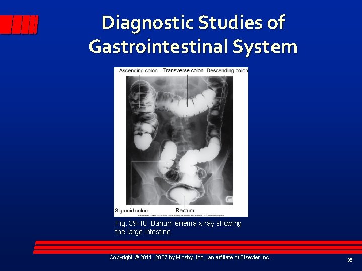 Diagnostic Studies of Gastrointestinal System Fig. 39 -10. Barium enema x-ray showing the large