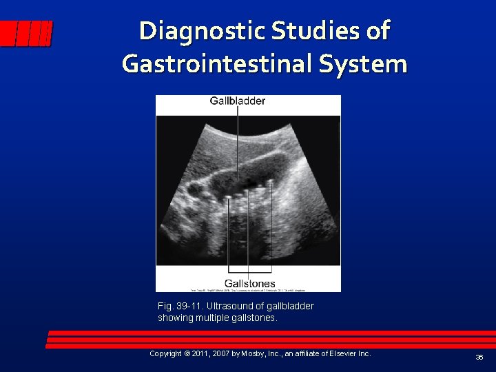 Diagnostic Studies of Gastrointestinal System Fig. 39 -11. Ultrasound of gallbladder showing multiple gallstones.