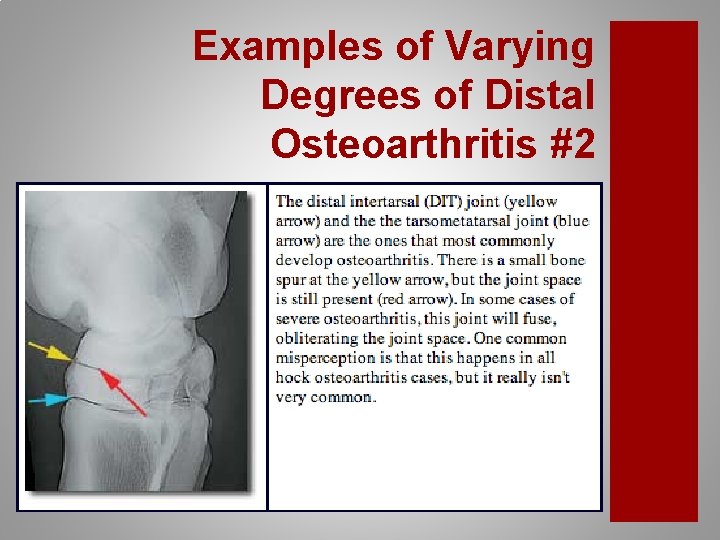 Examples of Varying Degrees of Distal Osteoarthritis #2 