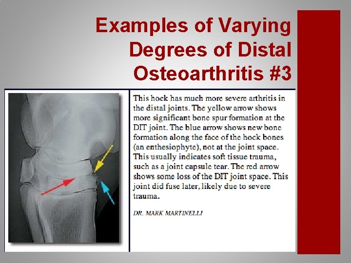 Examples of Varying Degrees of Distal Osteoarthritis #3 