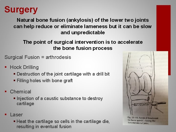 Surgery Natural bone fusion (ankylosis) of the lower two joints can help reduce or