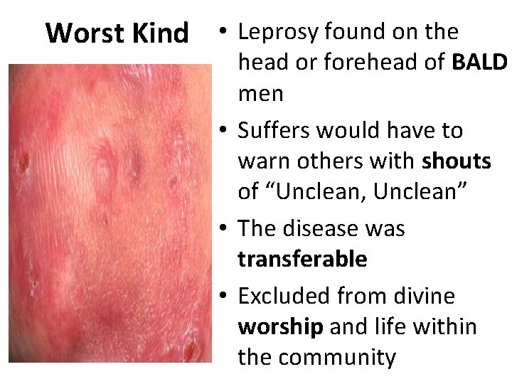Worst Kind • Leprosy found on the head or forehead of BALD men •