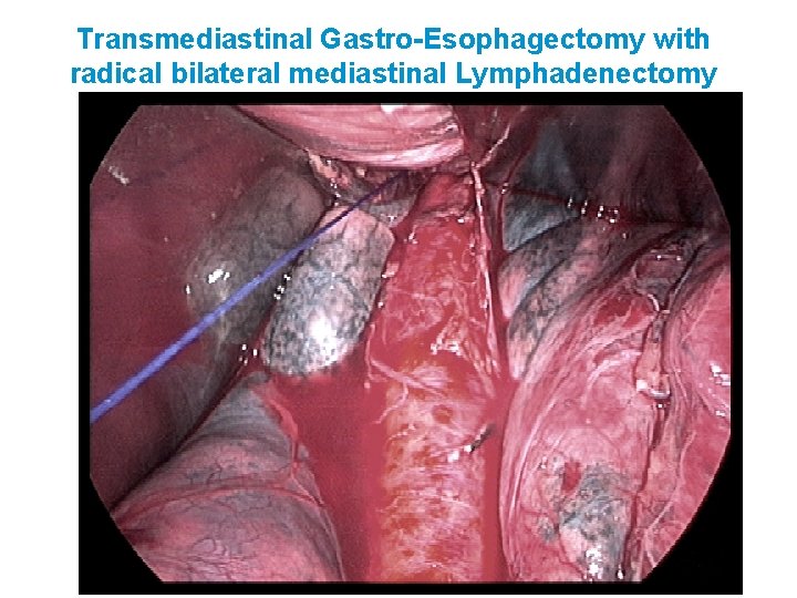 Transmediastinal Gastro-Esophagectomy with radical bilateral mediastinal Lymphadenectomy 