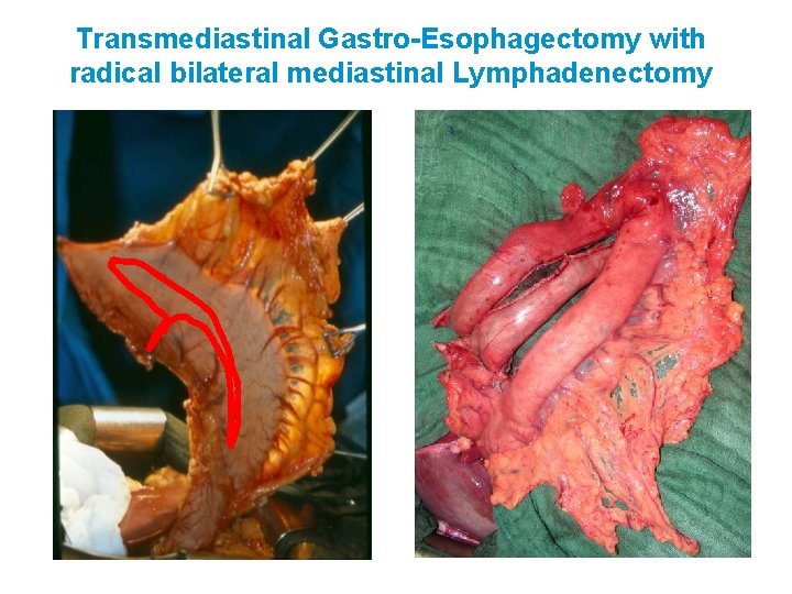 Transmediastinal Gastro-Esophagectomy with radical bilateral mediastinal Lymphadenectomy 