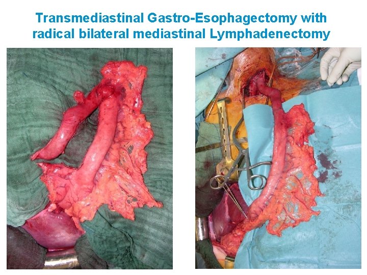 Transmediastinal Gastro-Esophagectomy with radical bilateral mediastinal Lymphadenectomy 