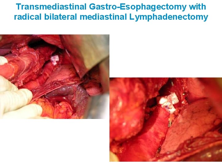 Transmediastinal Gastro-Esophagectomy with radical bilateral mediastinal Lymphadenectomy 