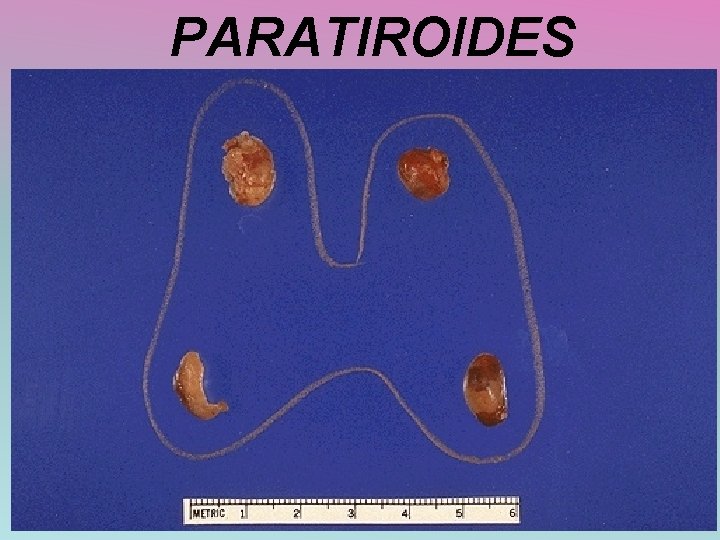 PARATIROIDES 