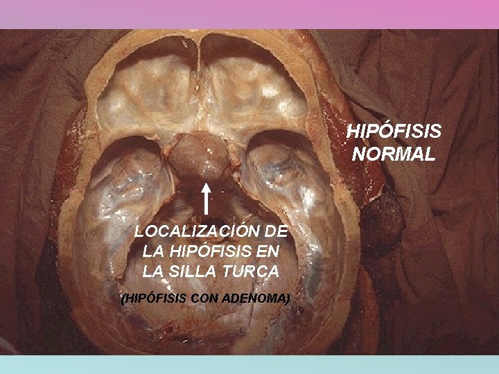 HIPÓFISIS NORMAL LOCALIZACIÓN DE LA HIPÓFISIS EN LA SILLA TURCA (HIPÓFISIS CON ADENOMA) 