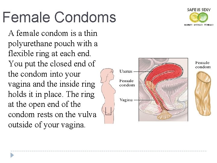 Female Condoms A female condom is a thin polyurethane pouch with a flexible ring