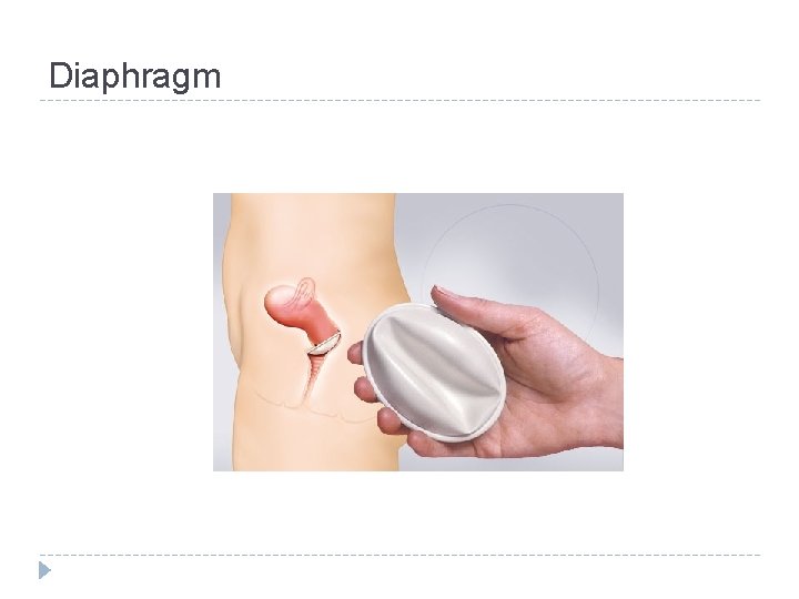 Diaphragm 