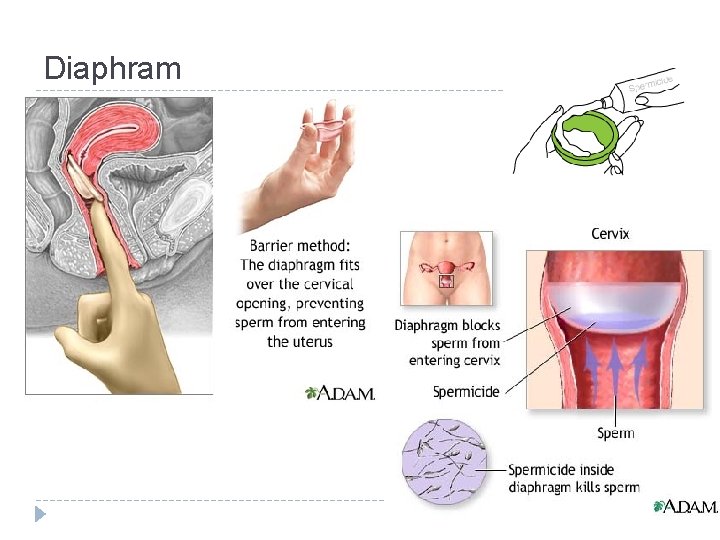 Diaphram 