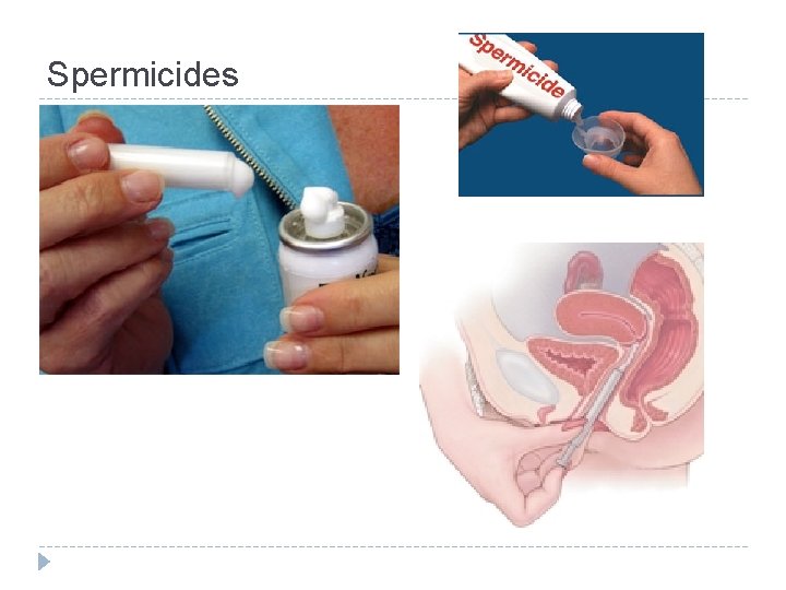 Spermicides 
