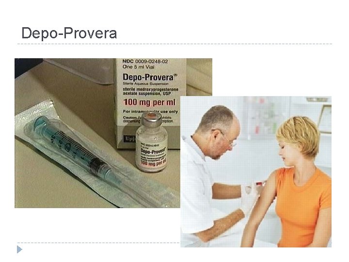 Depo-Provera 