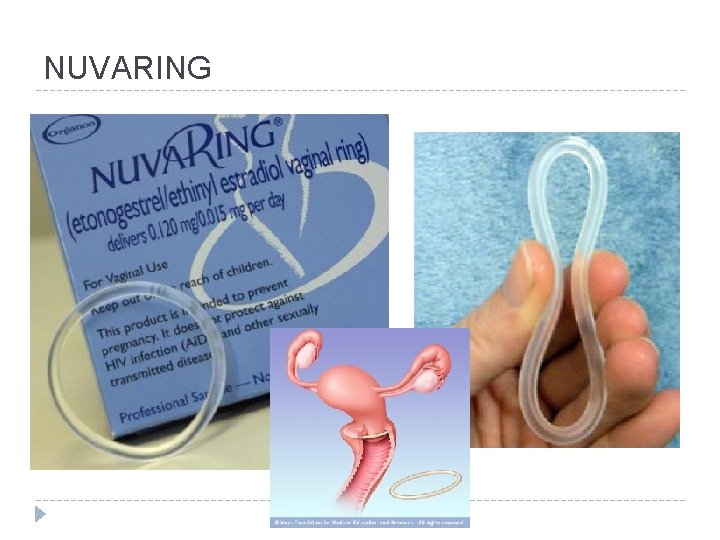NUVARING 