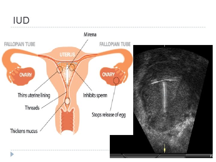 IUD 