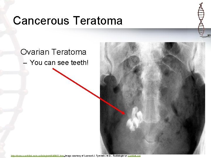 Cancerous Teratoma Ovarian Teratoma – You can see teeth! http: //home. earthlink. net/~radiologist/tf/040802. htm