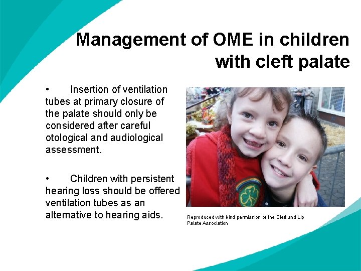 Management of OME in children with cleft palate • Insertion of ventilation tubes at