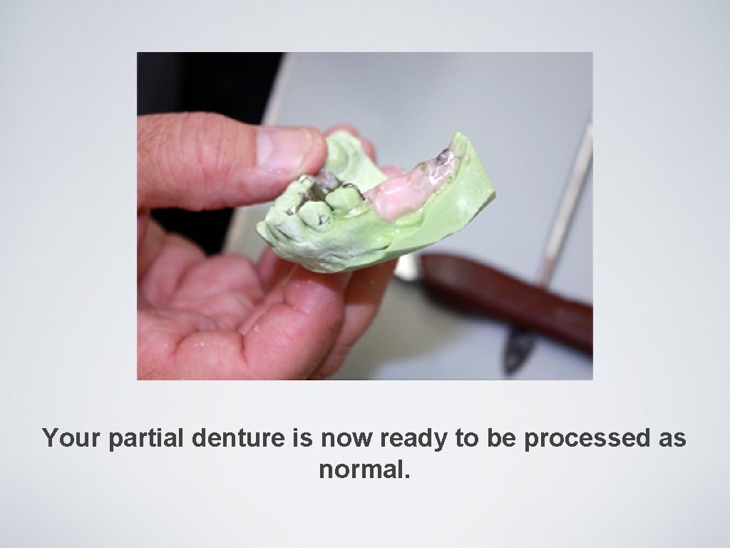 Your partial denture is now ready to be processed as normal. 