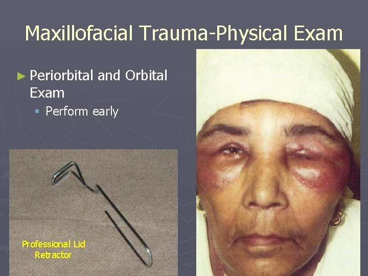 Maxillofacial Trauma-Physical Exam ► Periorbital Exam and Orbital § Perform early Professional Lid Retractor