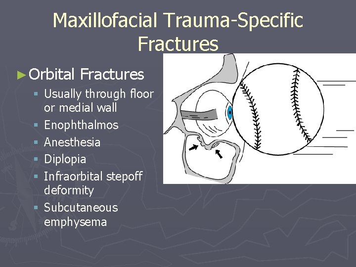 Maxillofacial Trauma-Specific Fractures ► Orbital Fractures § Usually through floor or medial wall §