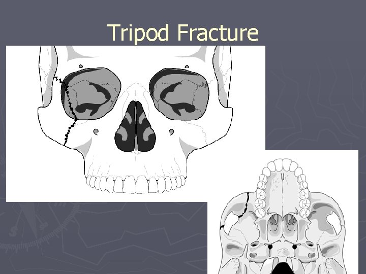 Tripod Fracture 