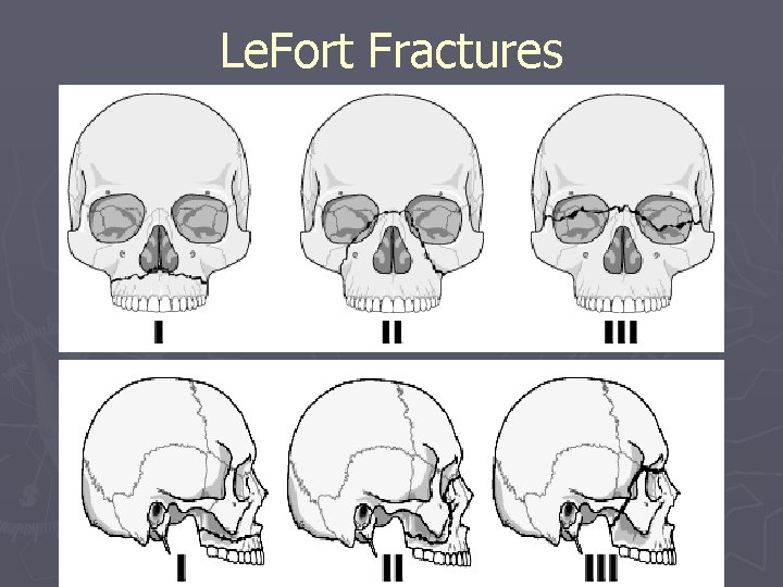 Le. Fort Fractures 