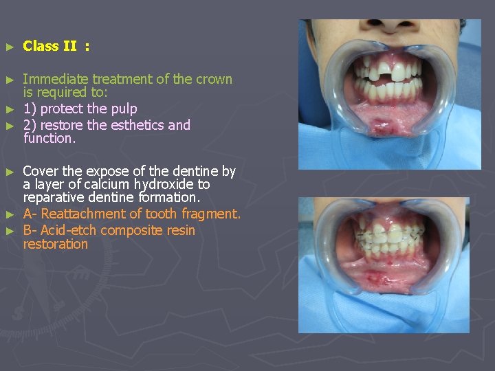 ► Class II : Immediate treatment of the crown is required to: ► 1)