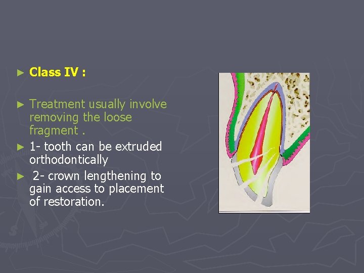 ► Class IV : Treatment usually involve removing the loose fragment. ► 1 -