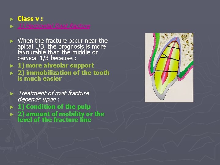 ► ► Class v : 1) Horizontal Root fracture When the fracture occur near